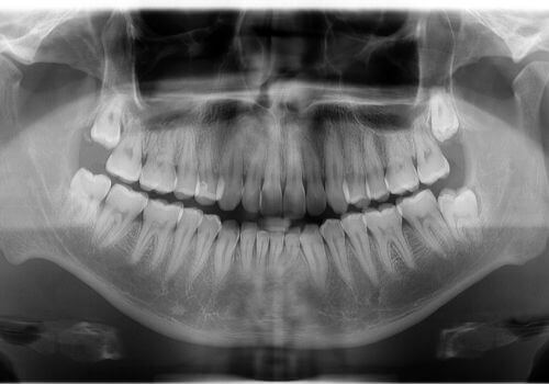 Panoramic dental X-ray of a patient's upper and lower jaws