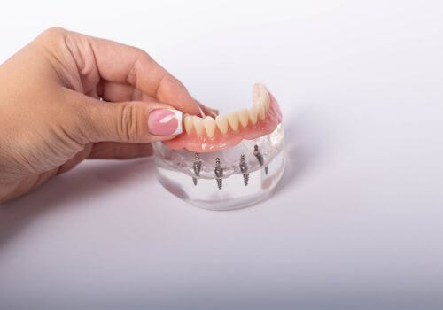 An implant-supported denture held in a gloved hand, showing the implant attachments