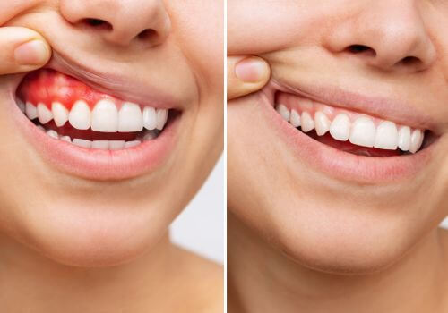 Healthy gums side by side with gums affected by periodontal disease
