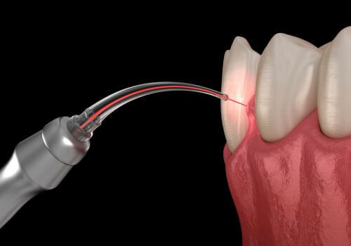 Illustration of a dental laser fiber treating the gum line during a LANAP procedure