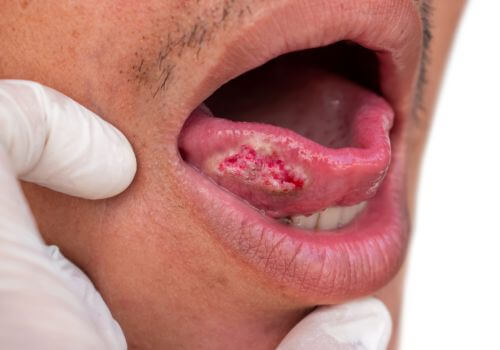 Squamous cell carcinoma of tongue. Oral cancer found during dental screening