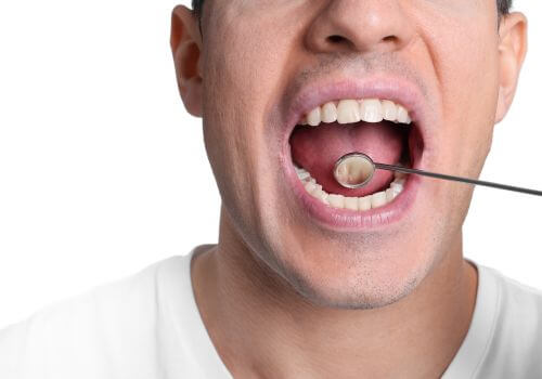 Oral cancer screening, male patient with dental mirror in his mouth
