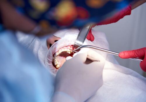 Sinus lift in male patient
