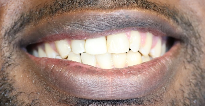 Close-up of Antwone’s smile after treatment