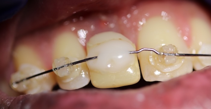 Close-up of Antwone’s teeth before treatment