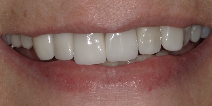 Close-up of Cheryl’s smile after treatment