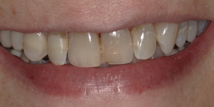 Close-up of Cheryl’s teeth before treatment