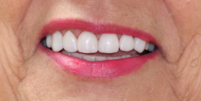 Close-up of Diane’s smile after treatment