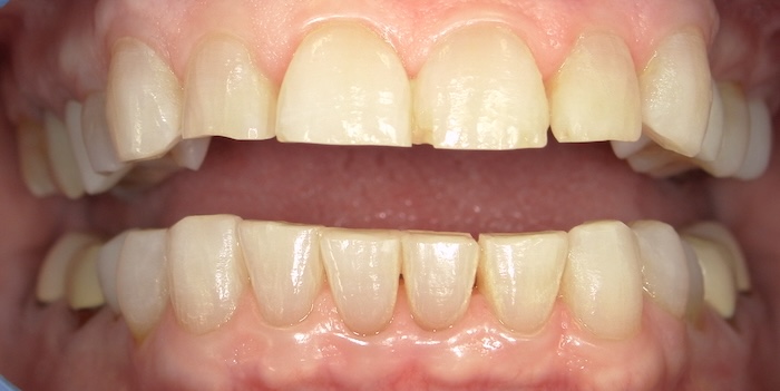 Close-up of Diane’s teeth before treatment