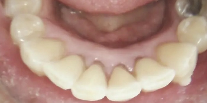 Close-up of Kent’s smile after treatment
