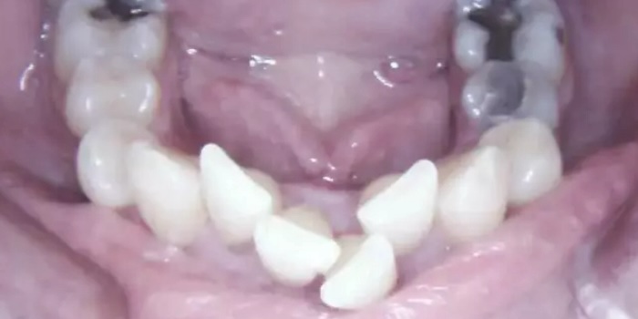 Close-up of Kent’s teeth before treatment