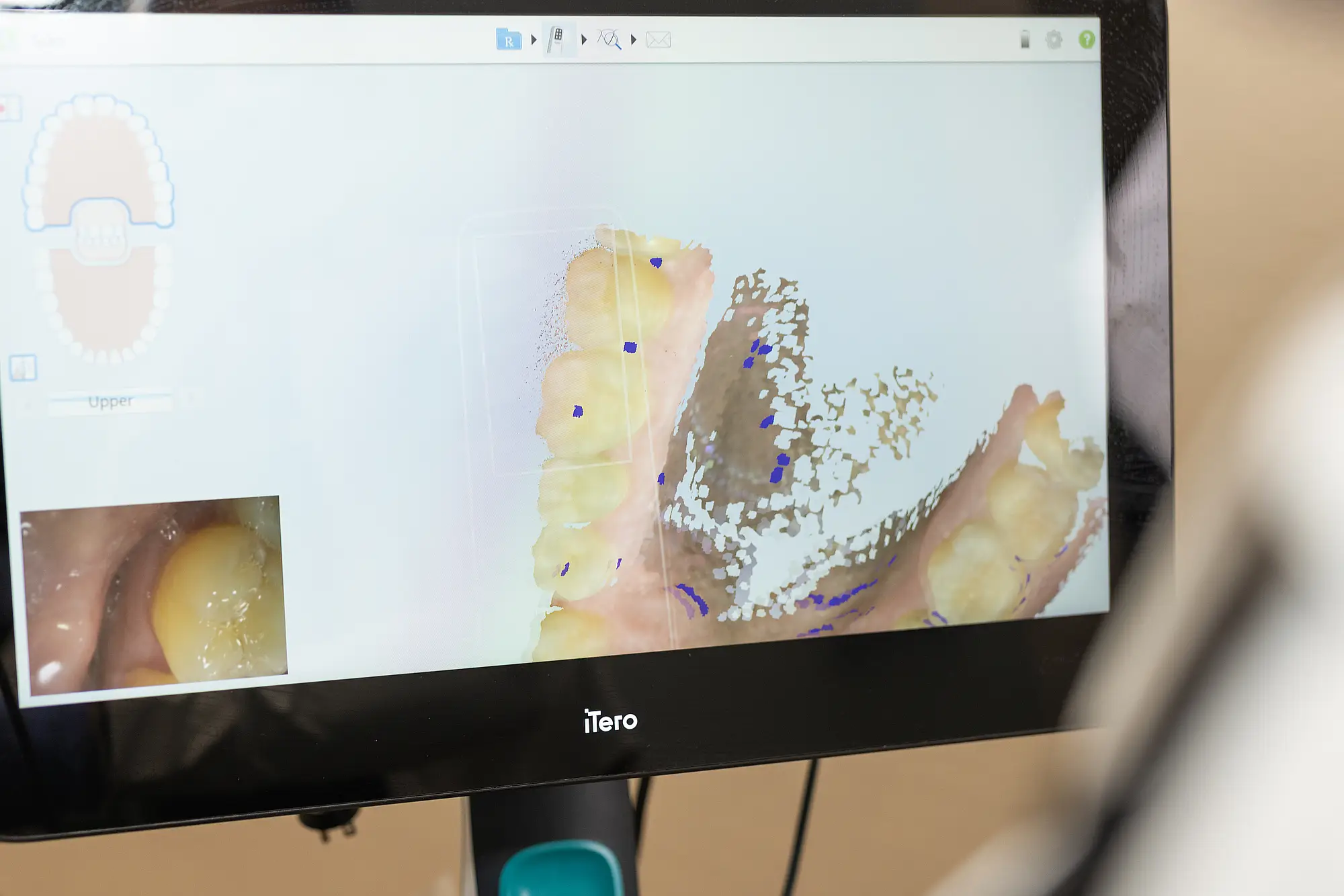 Scanner screen showing a digital scan of a patient's teeth