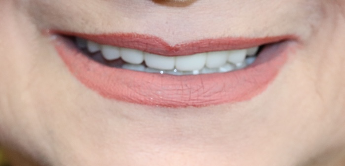 Close-up of Richelle’s smile after treatment