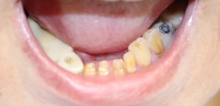 Close-up of Richelle’s teeth before treatment