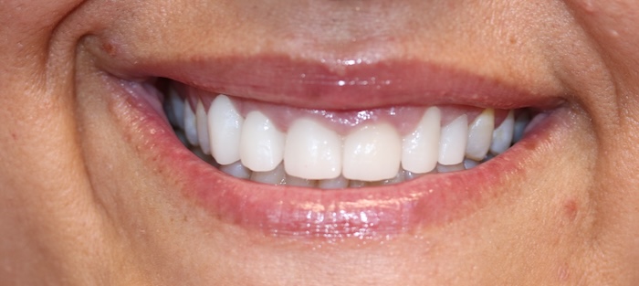 Close-up of Sheara’s smile after treatment