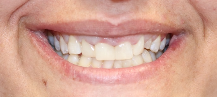 Close-up of Sheara’s teeth before treatment