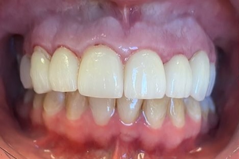 Close-up of Steve’s smile after treatment