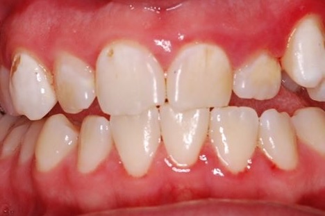 Close-up of Steve’s teeth before treatment