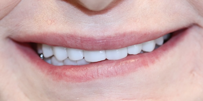 Close-up of Terry’s smile after treatment