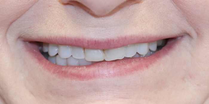 Close-up of Terry’s teeth before treatment