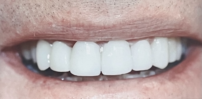 Close-up of Tom’s smile after treatment