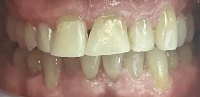 Close-up of Tom’s teeth before treatment